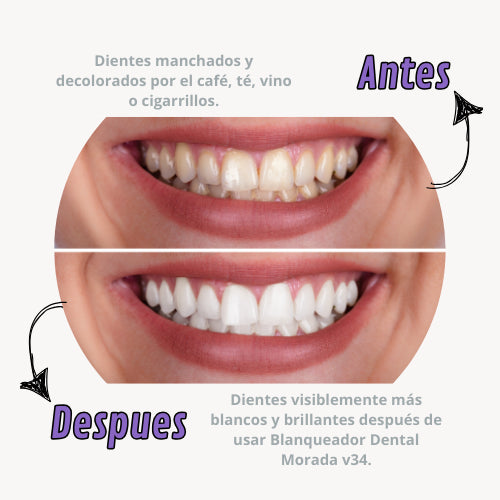 Blanqueador Dental SmileKit - La Revolución para una sonrisa radiante al Instante