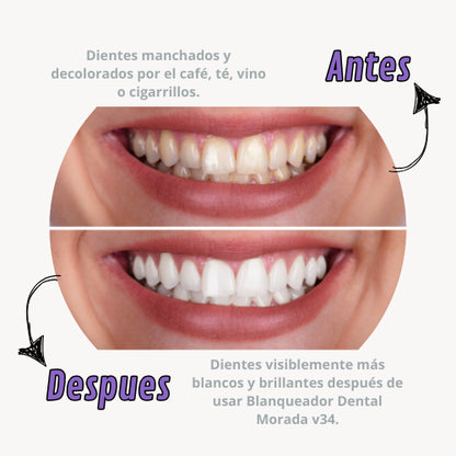 Blanqueador Dental SmileKit - La Revolución para una sonrisa radiante al Instante